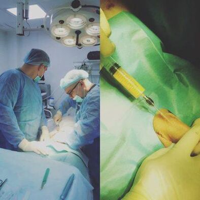 O îngroșare a penisului este posibilă cu ajutorul unei operații