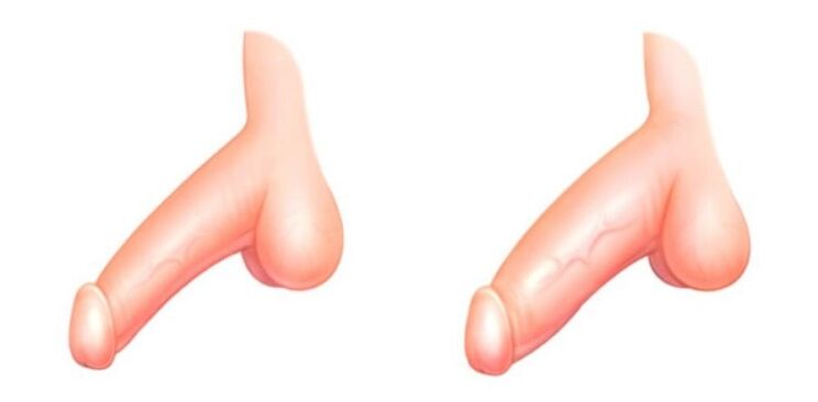 Penis înainte și după mărire